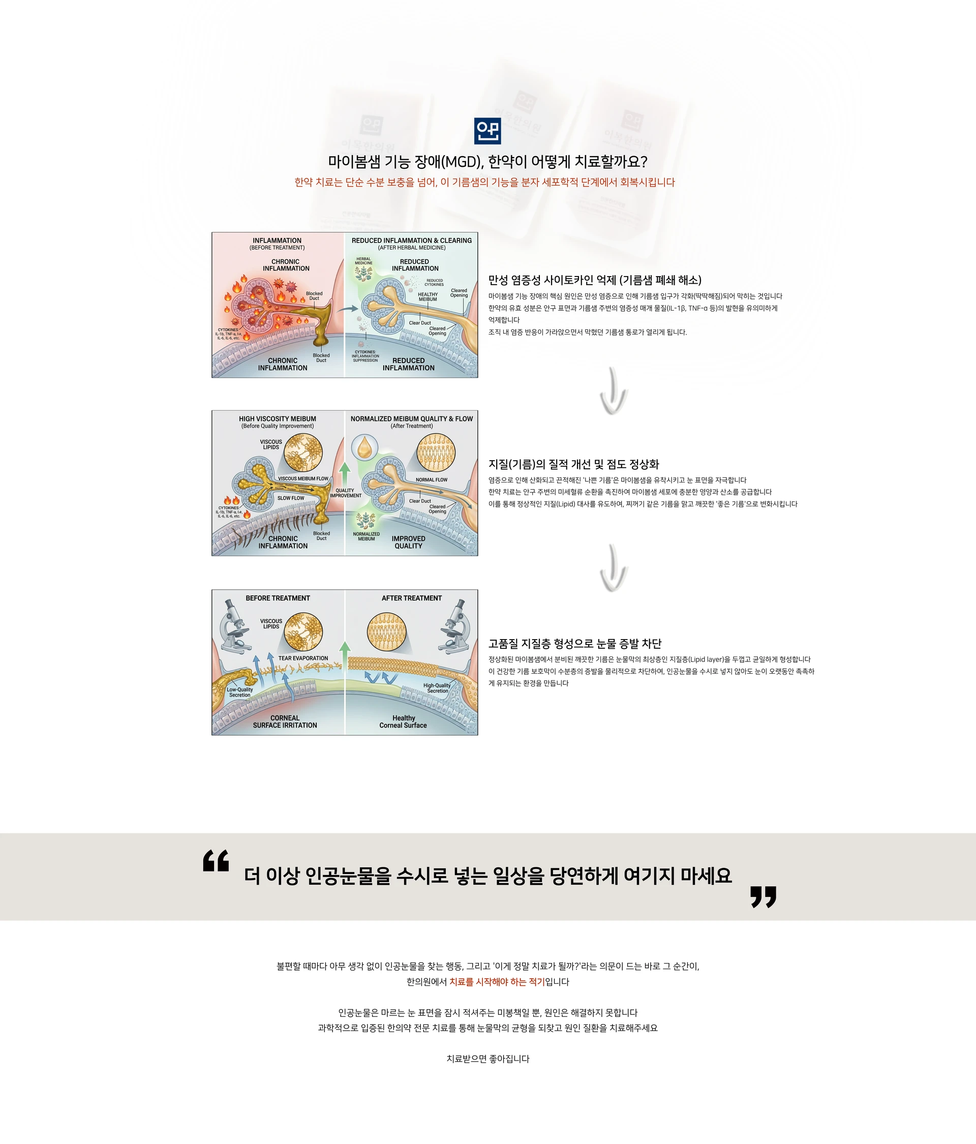 마이봄샘 기능 장애(MGD), 한약이 어떻게 치료할까요? 한약 치료는 단순 수분 보충을 넘어, 이 기름샘의 기능을 분자 세포학적 단계에서 회복시킵니다. 만성 염증성 사이토카인 억제(기름샘 폐쇄 해소) — INFLAMMATION (BEFORE TREATMENT) / REDUCED INFLAMMATION & CLEARING (AFTER TREATMENT). 지질(기름)의 질적 개선 및 점도 정상화 — HIGH VISCOSITY MEIBUM / NORMALIZED MEIBUM QUALITY & FLOW. 고품질 지질층 형성으로 눈물 증발 차단 — BEFORE TREATMENT / AFTER TREATMENT, CORNEAL SURFACE IRRITATION / Healthy Corneal Surface. 더 이상 인공눈물을 수시로 넣는 일상을 당연하게 여기지 마세요. 인공눈물은 마르는 눈 표면을 잠시 적셔주는 미봉책일 뿐, 원인은 해결하지 못합니다. 치료받으면 좋아집니다
